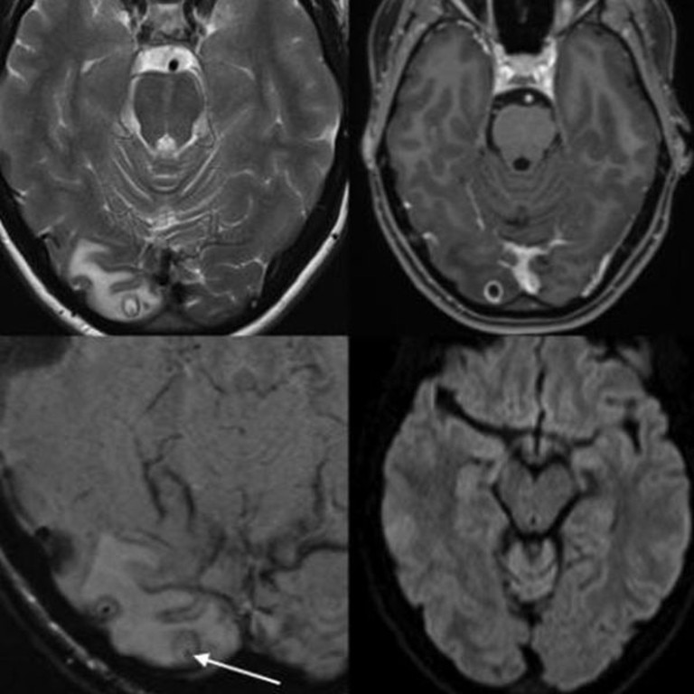 Doctors initially believed the woman had a tumour, but an MRI scan on her brain revealed she instead had a cyst full of tapeworm larvae. Picture: The American Journal of Tropical Medicine and Hygiene