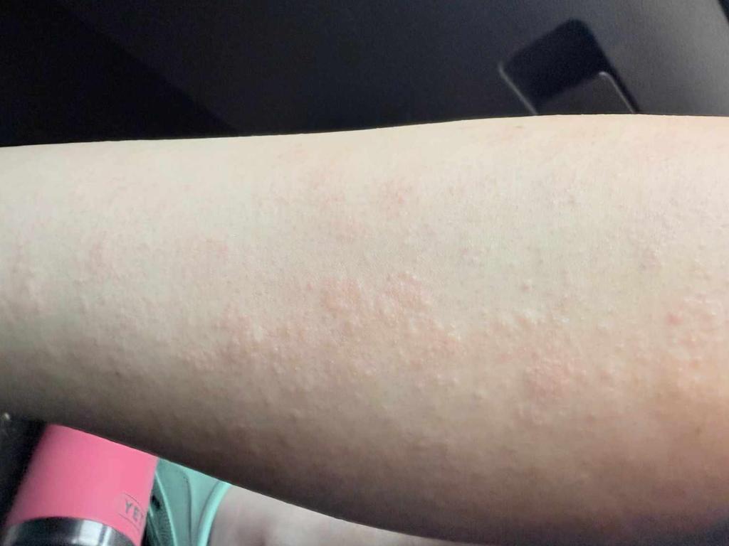 Larissa's daughter received skin irritation after swimming in the Emerald Aquatic Centre on several occasions. Supplied: Larissa Watson