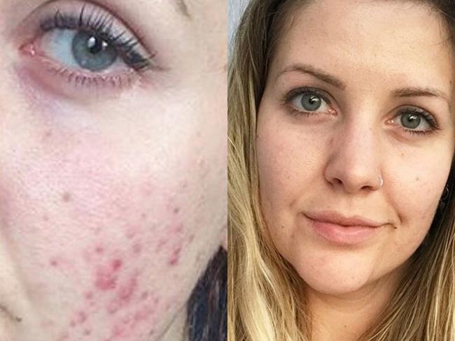 It wasn’t until she came off her contraceptive pill at 24 that her skin flared up like never before. Picture: Media Drum World/australscope