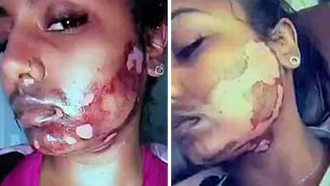 As a part of her recovery she had to ‘peel the skin on her face back to let it heal’.