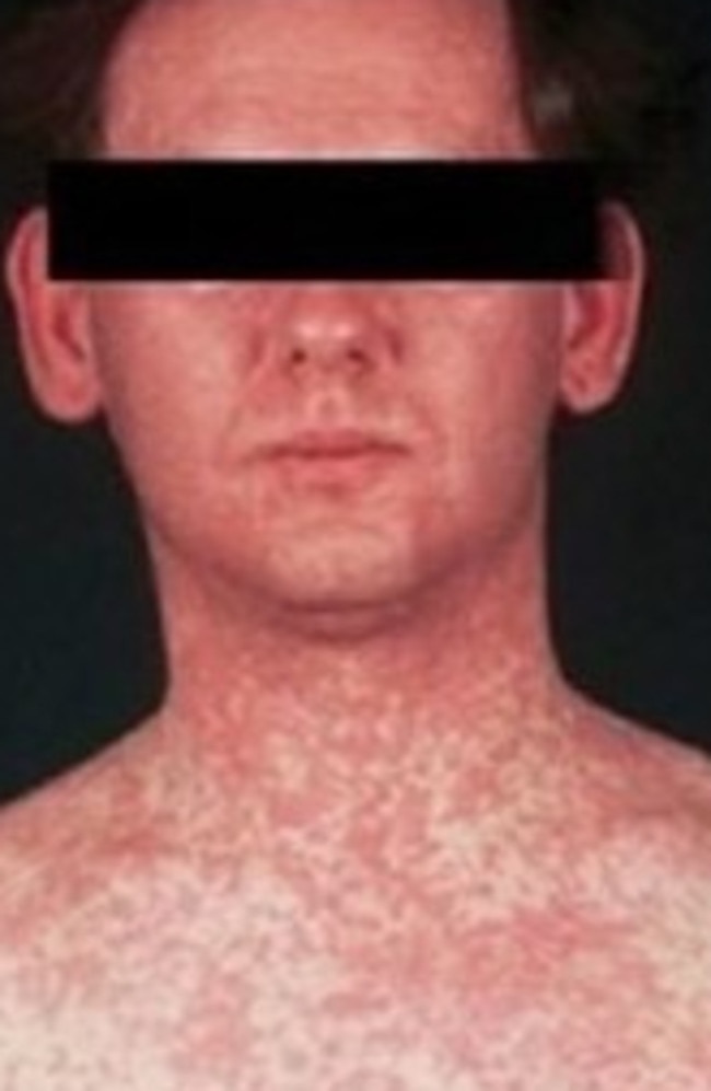 A typical measles rash. Picture: Victoria Department of Health