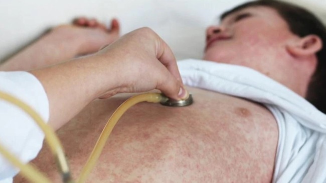 Measles causes a rash. Picture: ACS