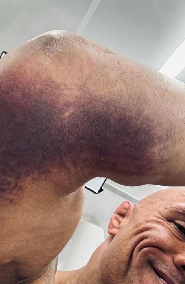 The Rock shows off injury while filming The Smashing Machine.