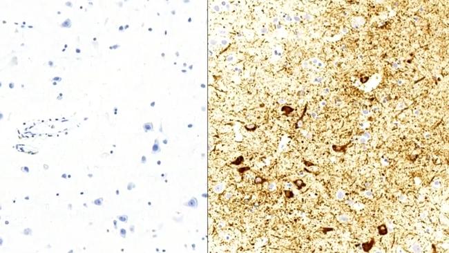 These are tissue samples - a healthy brain on the left, the right Keith's with brown CTE lesions. Photo: Channel 9