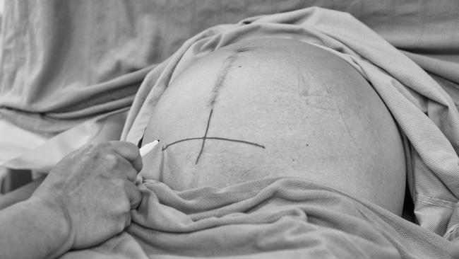 Being prepared for C-section. Picture: Natalie Grono