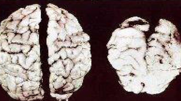 A normal brain (left) and one of a child with fetal alcohol spectrum disorder