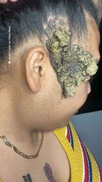 Woman has a giant growth removed from her face after years of torment.