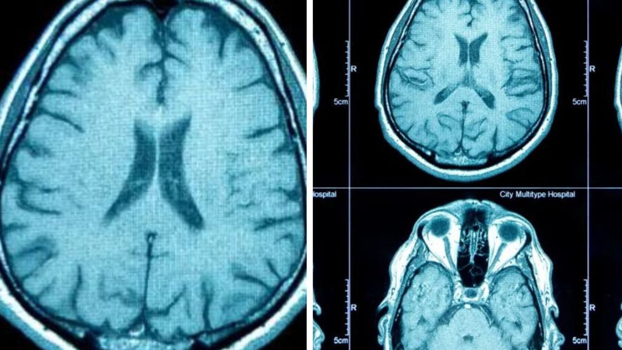 Brain scan reveals sleep habit is ageing us