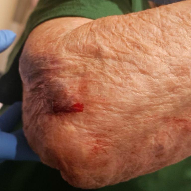 One aged care resident suffered injuries after falling getting on a bus without help. Picture: Supplied
