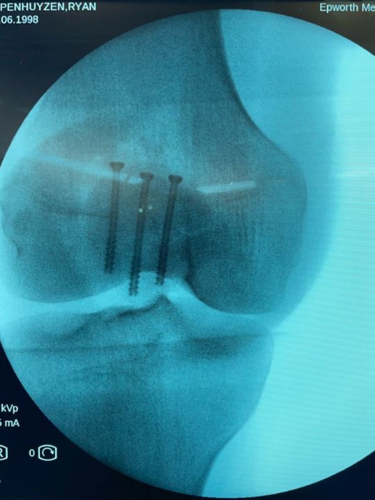 X-rays reveal the extent of Ryan Papenhuyzen’s injury.