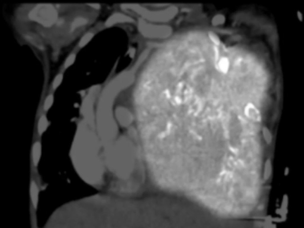 This is how Ellie’s tumour first looked in her chest in August.