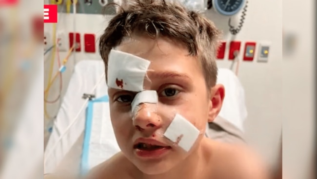 The boy required cosmetic surgery for his fractured nose. Source: 9News