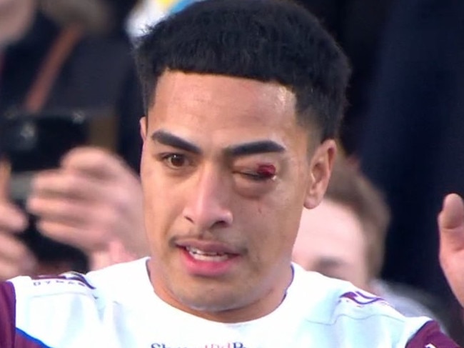 Lehi Hopoate with a nasty eye injury