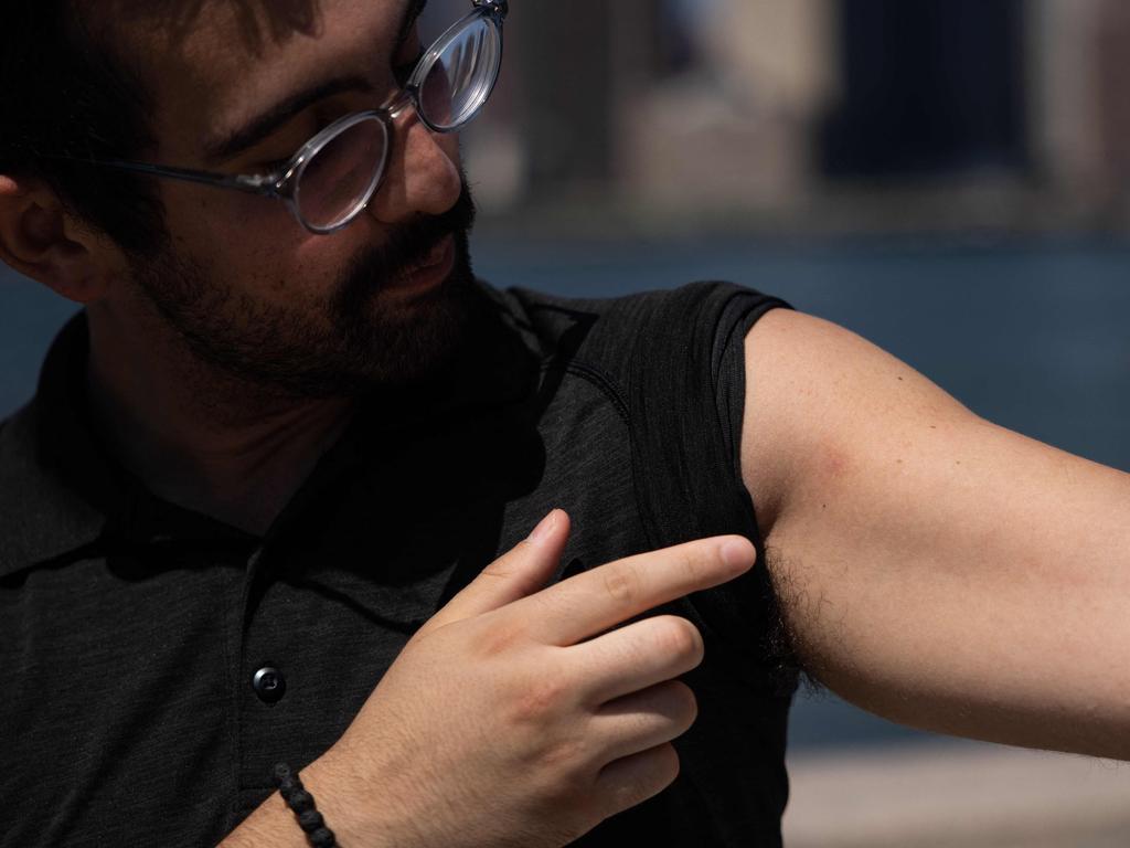 Kyle Planck, 26, who has recovered from monkeypox, shows scars from rashes on his skin during an interview in New York. Picture: AFP