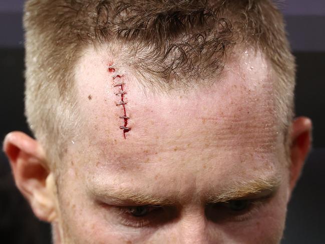 Staples in Jack Riewoldt’s forehead after a heavy knock during the 1st qtr. Picture: Michael Klein