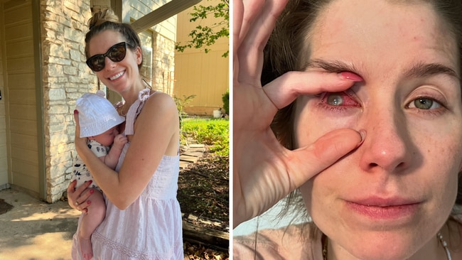 Rachel was returning from the gym when her eye started to feel scratchy. Picture: rachelprochnow/Instagram