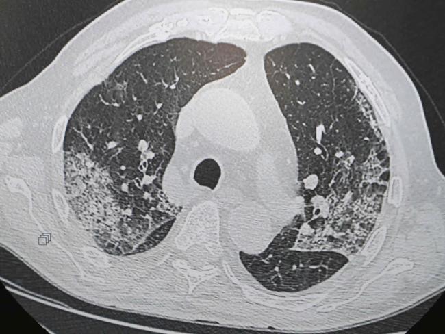 A picture taken on April 8, 2020 shows a scanner of the lungs of a patient infected by COVID-19 at the Floreal clinic in Bagnolet, near Paris, on the twenty-third day of a lockdown aimed at curbing the spread of COVID-19 (novel coronavirus) in France. (Photo by Ludovic MARIN / AFP)