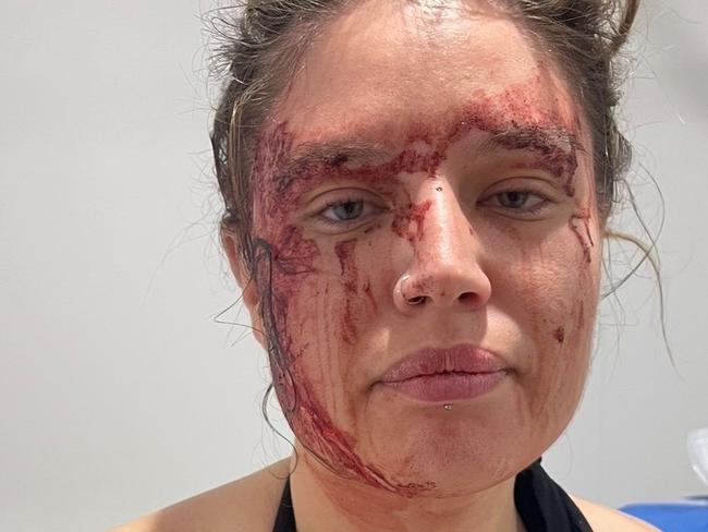 ‘A dog nearly killed me’: 28yo claims she was viciously attacked