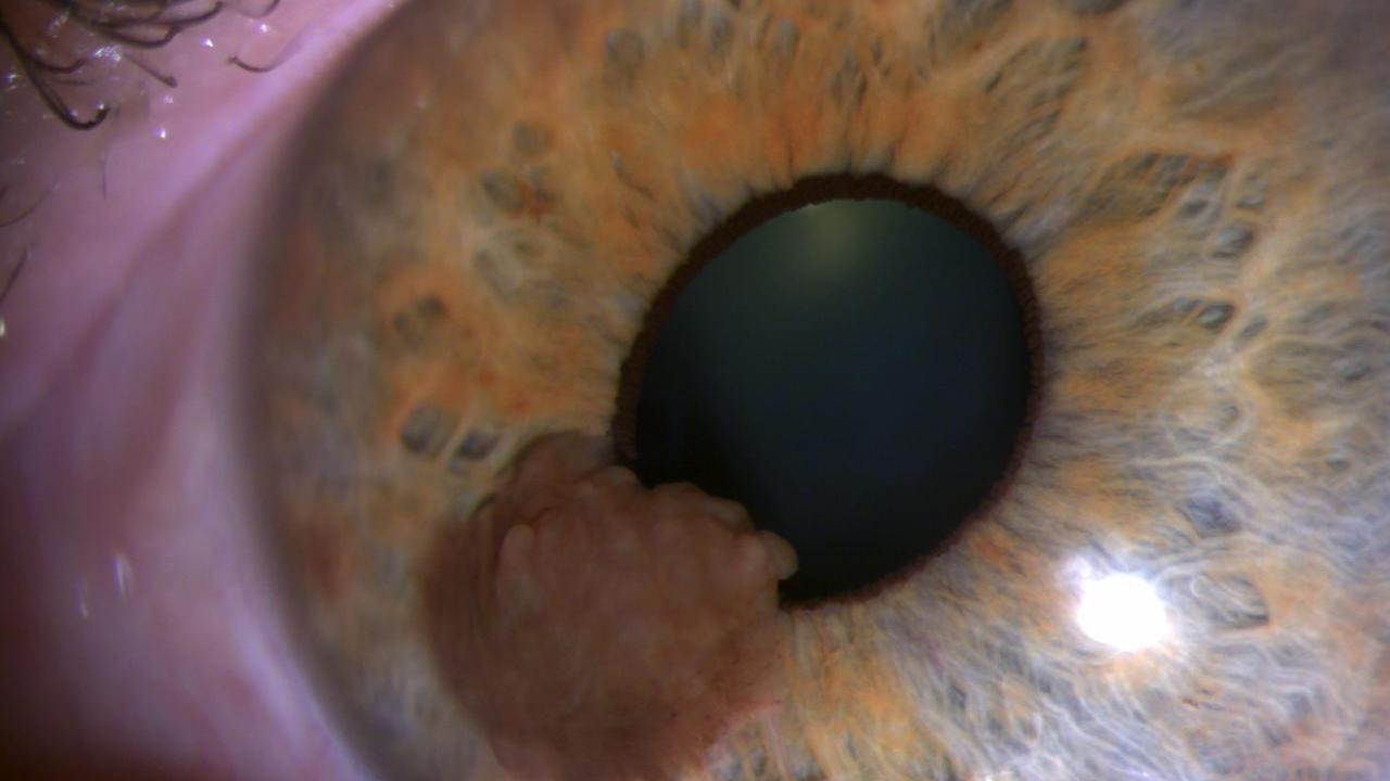 Qimr Berghofer Researchers Unlock Some Of The Mysteries Of Eye