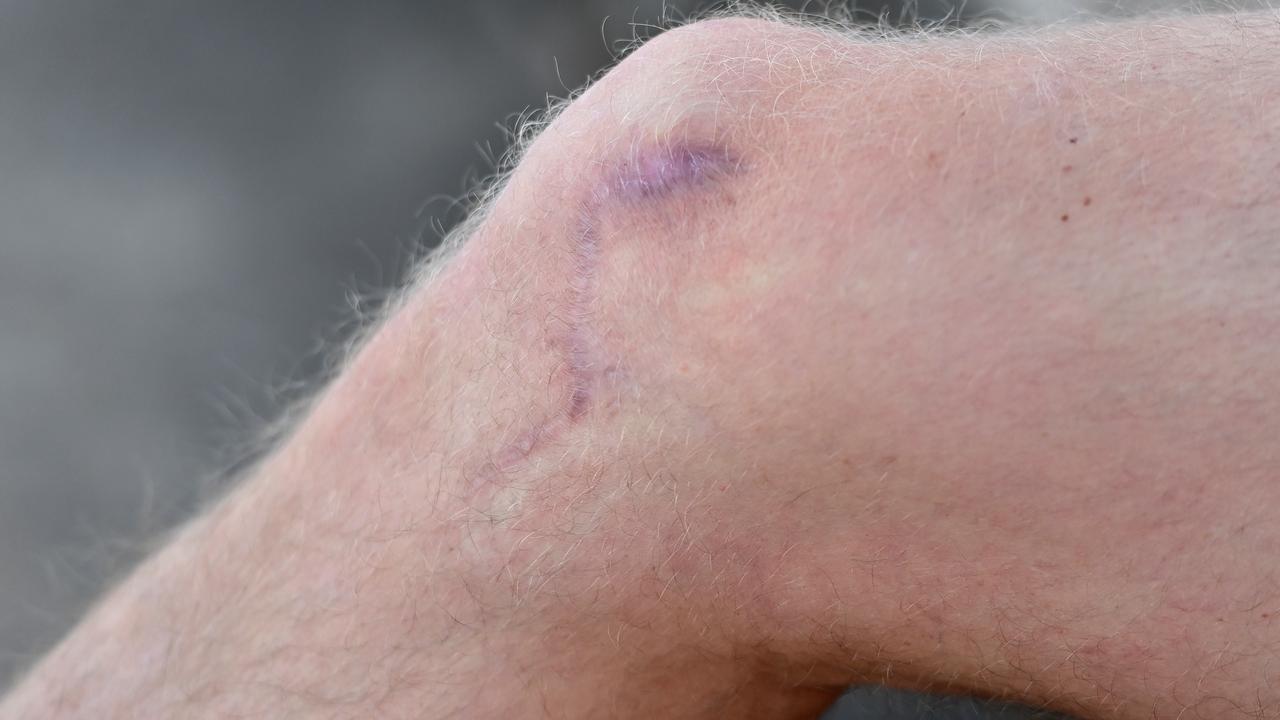 The scar that runs across Mani Liddy’s right knee. Picture: Keryn Stevens