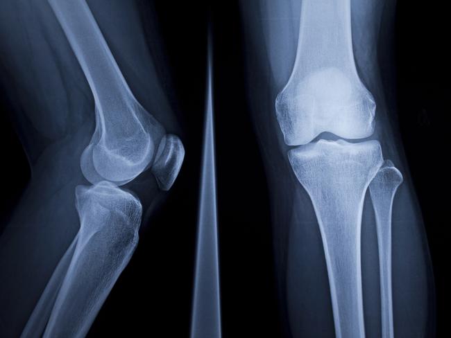 X-Ray of human knee  Picture: istock