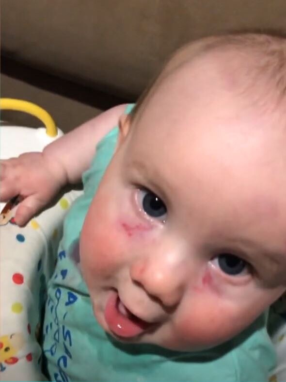 A Brisbane family claims their son Jack was left battered and bruised by an older child while at daycare. Picture: ABC 7.30/Angela Swindells