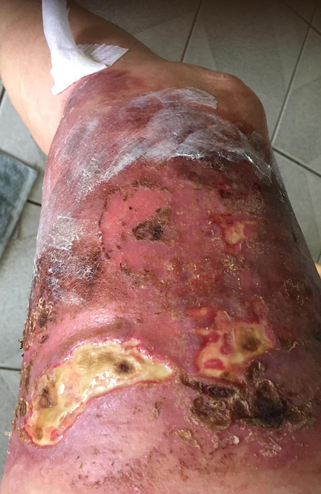 Celeste Stirrup's leg infection. Picture - contributed.