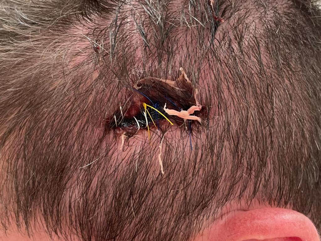 Mr Blacker's injuries. Picture: Supplied