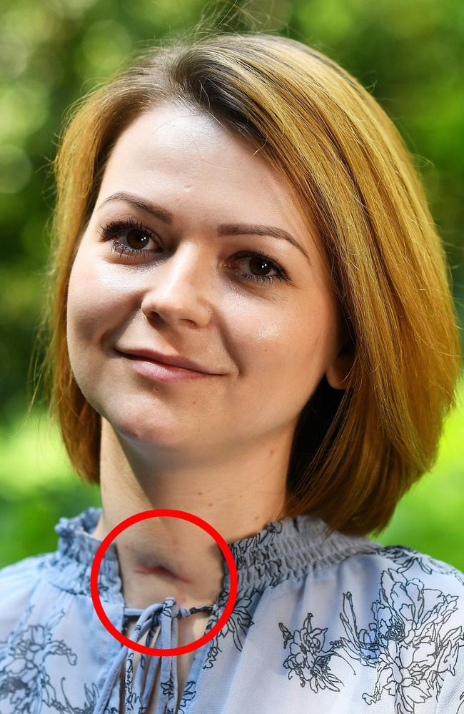 Yulia Skripal had a very visible scar after the procedure that saved her life.