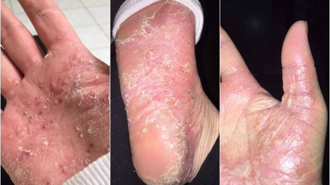 Nicole suffers from Palmoplantar Pustulosis - a skin condition that can cause blister-like sores on the the hands and feet. Picture: Supplied