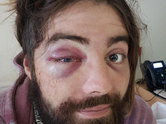 Bashing victim Elliott Harvey, who was left blind in one eye following attack in Brunswick nightclub.