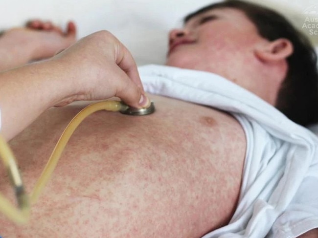 West Australia health authorities have issued a second measles warning. Picture: ACS