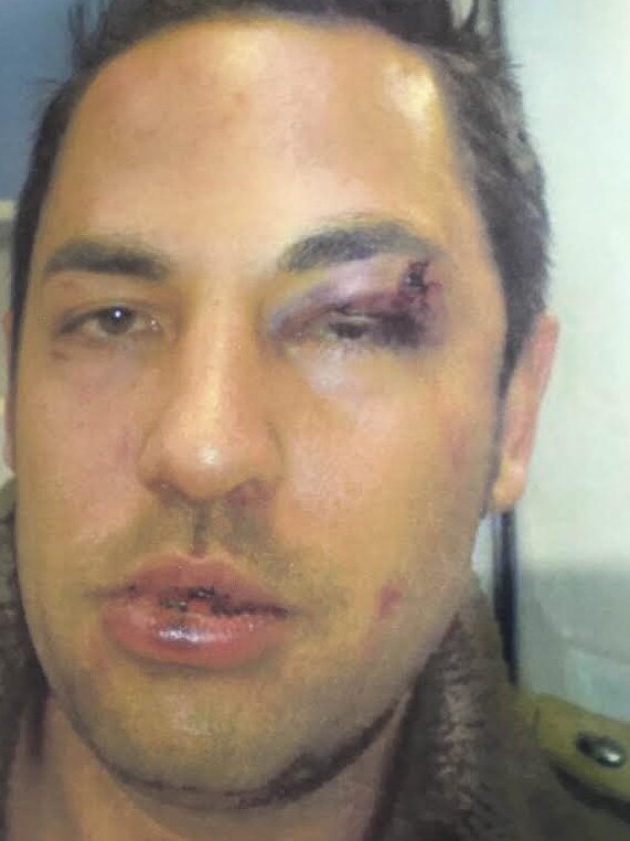 Injuries to Robert Paul Davies, who settled out of court after alleging he was assaulted by police.