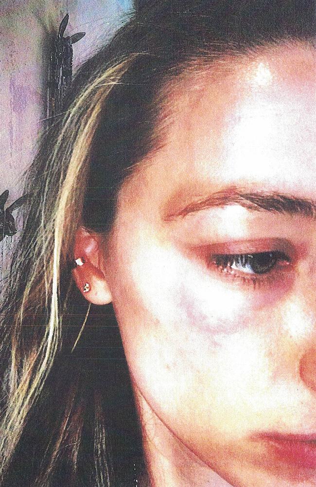 Amber Heard alleged Depp threw her mobile phone at her, bruising her face Picture: Splash News