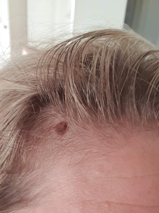 Ms Tomasek's sister had a melanoma discovered on her scalp in 2019 following a trip to the hairdresser. Picture: Supplied