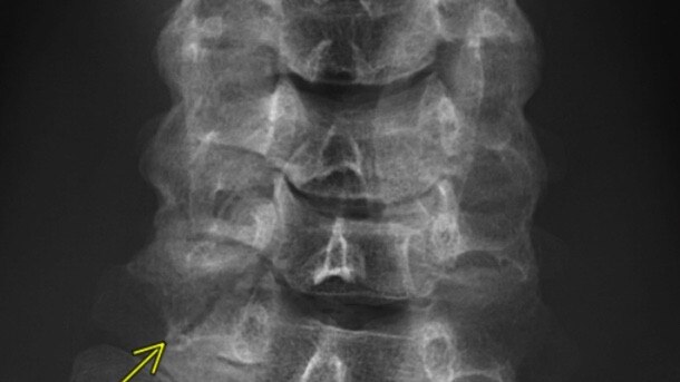 An X-ray of Hawthorn ruckman Ben McEvoy's neck. McEvoy fractured the C7 vertebrae in an accidental collision with a teammate at training. Picture: Supplied