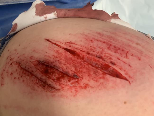 Mr Clements partner’s upper thigh before she received 25 stitches. Picture: Supplied.