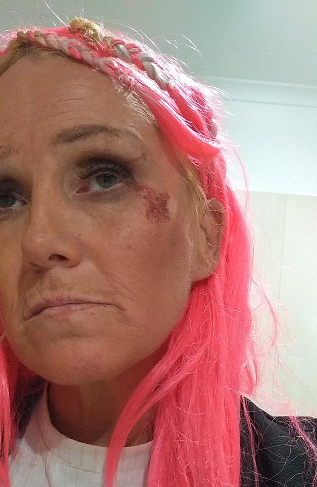 Injuries sustained by West Launceston woman Crystal Aldridge, 44, during an mistaken arrest by Tasmania Police officers at her unit on April 7, 2022. Picture: Supplied