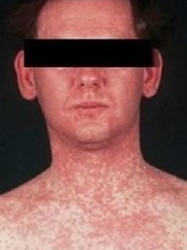 A typical measles rash. Picture: Victoria Department of Health