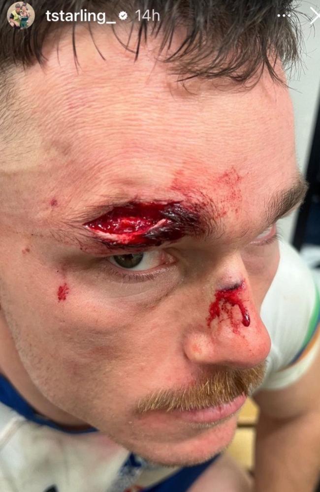 Raiders hooker Tom Starling's split head