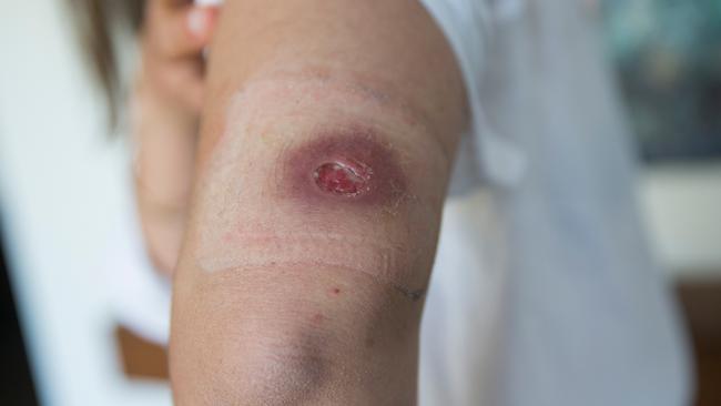 Authorities have warned residents of six northwest Melbourne suburbs to remain vigilant to the Buruli ulcer virus as cases rise. Picture: Paul Jeffers