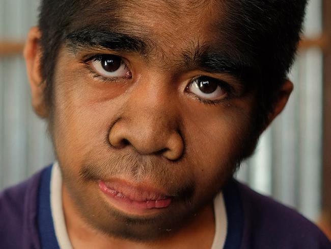 ONLINE ONLY - ONE TIME USAGE - PIC BY YULI SEPERI / CATERS NEWS - (PICTURED: Raihan at home) - Muhammad Raihan is revered as Hindu God in his village in North Kalimantan in Indonesia because of his peculiar appearance. The 13-year-old boy suffers from severe hair growth on his body that gives him a look of a werewolf. His whole face and arms and legs are covered with thick hair as long as 3cm. The boy, who studies in middle school and is often subjected to mockery by his classmates. But Raihan is unfazed with the ridicule and name-calling as he believes he is a blessed child of the God and wants to serve him as a cleric. - SEE CATERS COPY Picture: Caters News Agency