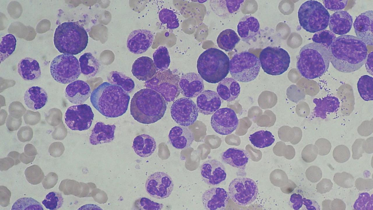 Chronic myeloid leukaemia occurs when bone marrow produces too many white blood cells that over time crowd the bone marrow and interfere with normal blood cell production. Picture: Wikipedia