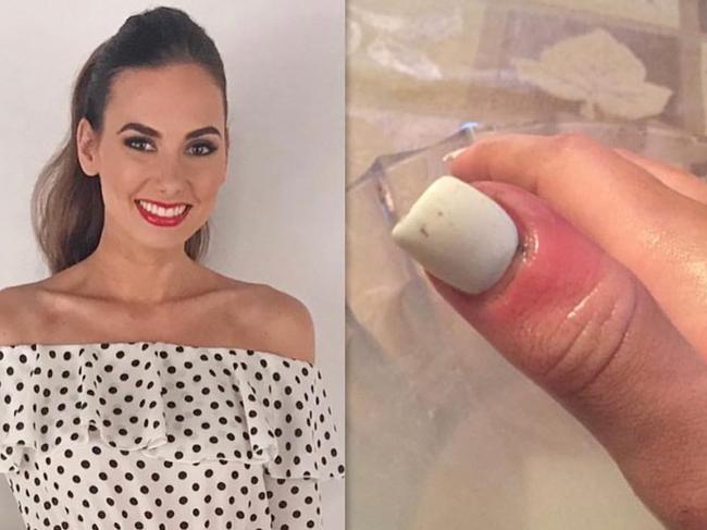 Karolina Jasko spotted a thin purple line on her thumb nail that turned out to be cancer.