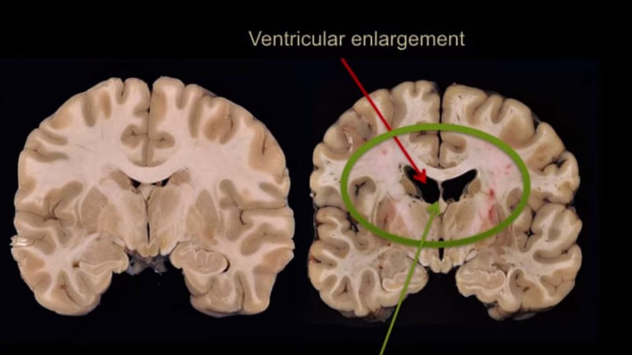 aaron-hernandez-netflix-documentary-investigates-cte-injury