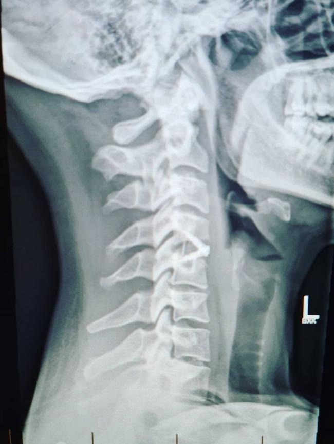 An X-ray of Dani Stevens’ neck. Picture: Instagram