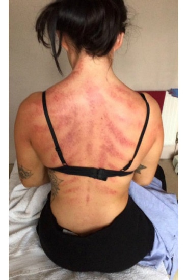 Hairdresser's photo shows bruised back and the physical toll of