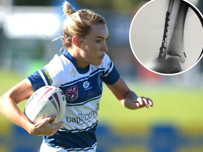 Rugby league player Jess Powell in action and inset the x-ray showing the plates and screws inserted in her injured ankle.