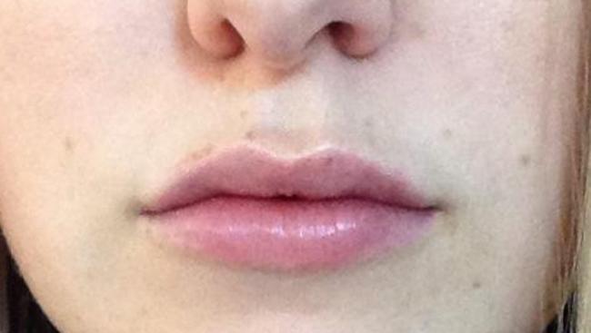 And after the lip procedure. Picture: Supplied