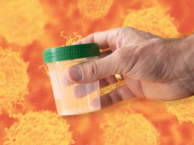 Analysis of prostate cancer cells allowed scientists to identify biomarkers that can be detected in urine. Picture: Getty Images/The Australian